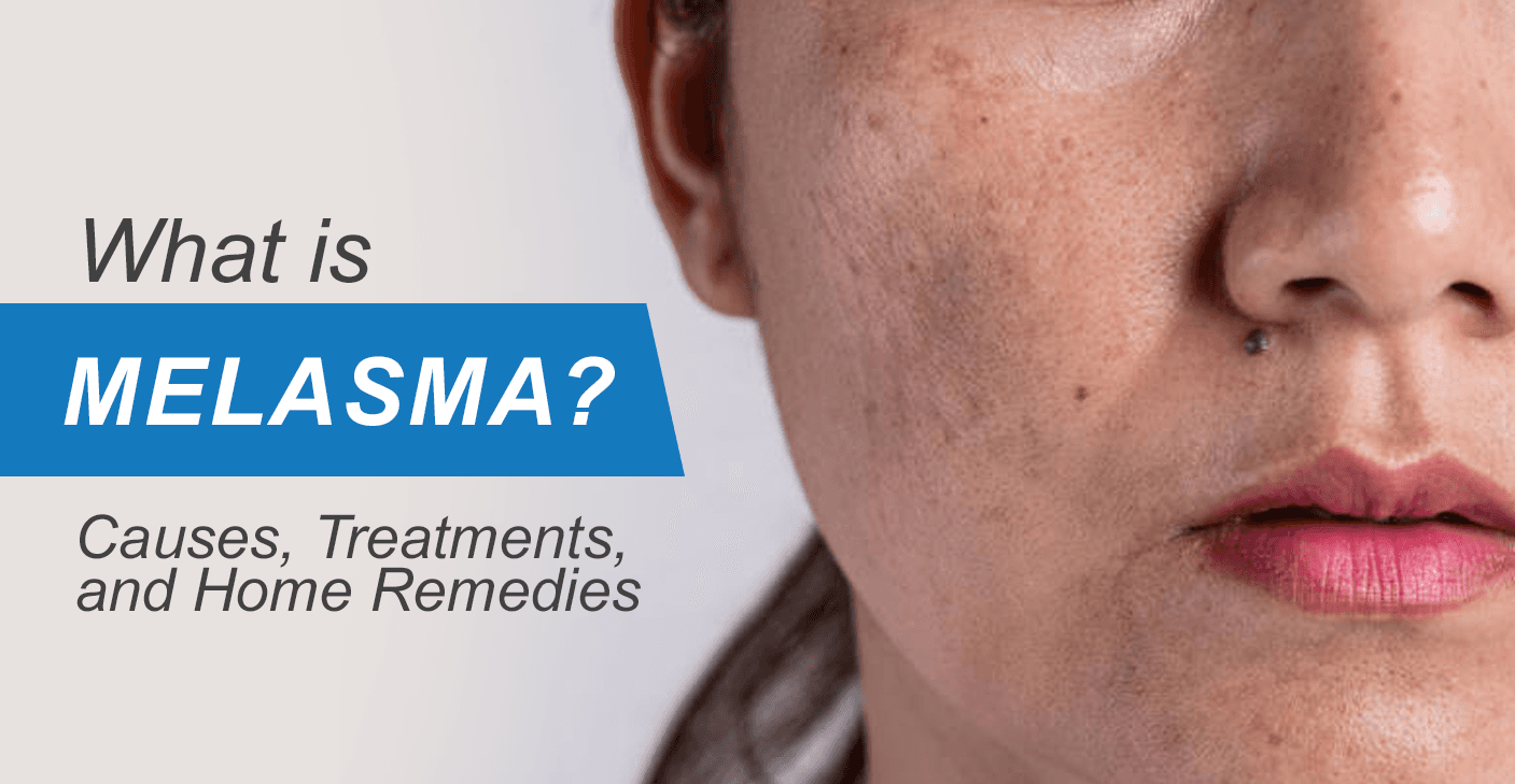 What is Melasma - Causes, Treatments, & Home Remedies