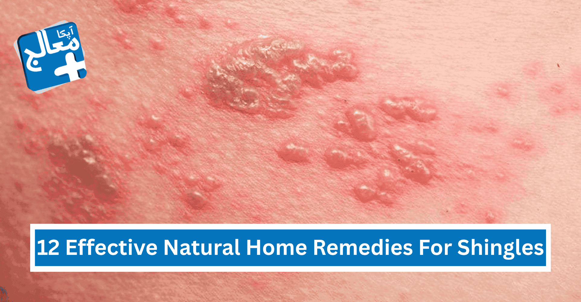 12 Effective Natural Home Remedies For Shingles | Apka Muaalij 12 Effective Natural Home Remedies For Shingles | Apka Muaalij